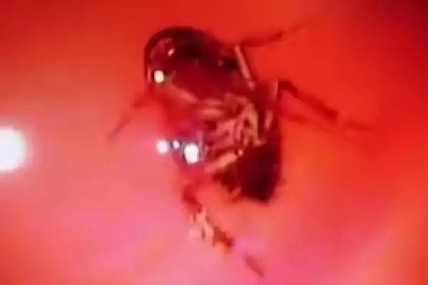 Unbelievable!! Doctors Pull Live Cockroach From Woman